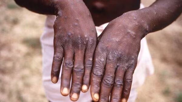 Monkeypox : COVID-19 પછી, હવે મંકીપોક્સે દસ્તક આપી છે, ભારતે સુરક્ષા વધારી https://www.pravinews.com/international-news/monkeypox-reaches-asia-after-covid-19-death-rate-is-3-percent-31721