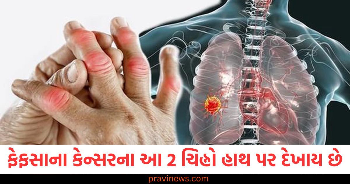 ફેફસાના કેન્સરના આ 2 ચિહ્નો હાથ પર દેખાય છે, જાણો તેનું નિવારણ https://www.pravinews.com/lifestyle/expert-skincare-tips-to-treat-and-prevent-pimples-naturally-article-80188