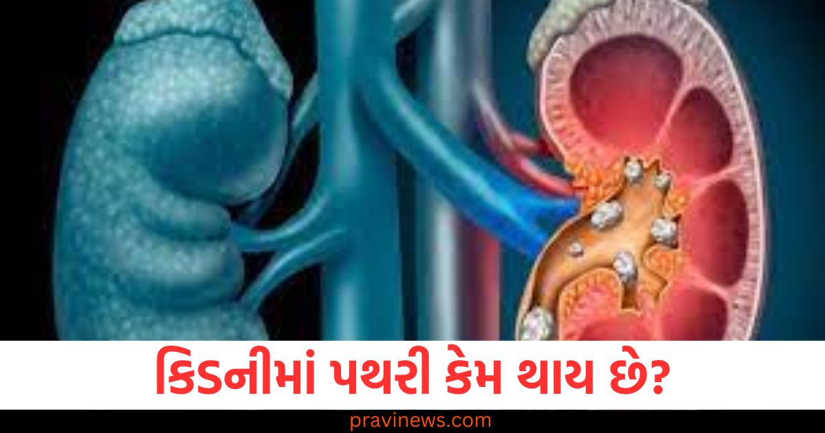 કિડનીમાં પથરી કેમ થાય છે? ડોક્ટરે જણાવ્યા 5 સામાન્ય કારણો, આ રીતે રાખો સાવચેતી. https://www.pravinews.com/lifestyle/health-health-tips-protein-shake-beneficial-or-harmful-for-body-know-from-experts-83440