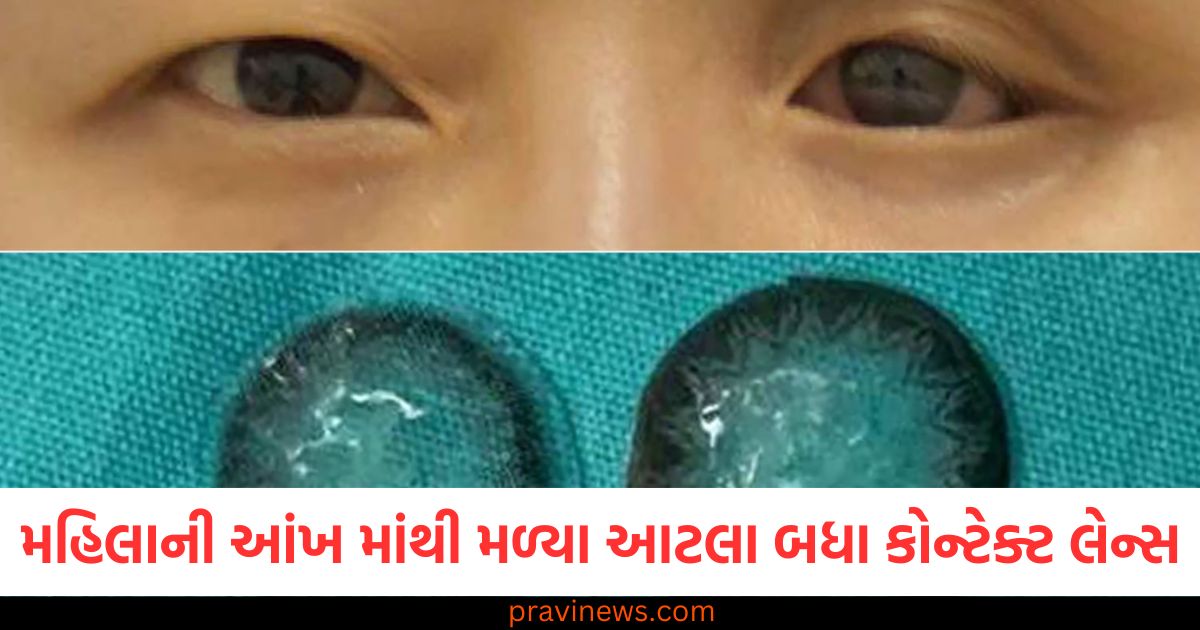 અરે બાપરે... આ શું? ડોક્ટરોને એક મહિલાની આંખ પાછળ ખોવાઈ ગયેલા આટલા બધા કોન્ટેક્ટ લેન્સ મળ્યા https://www.pravinews.com/trending/climbing-everest-without-feet-top-5-guinness-world-records-of-the-year-2024-will-surprise-you-64999